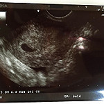 妊娠２か月　エコー写真