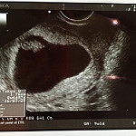 妊娠３か月　エコー写真