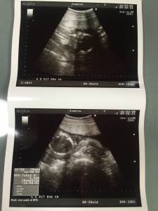 エコー写真 妊娠6ヵ月