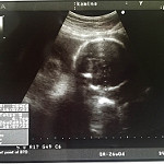 エコー　妊娠７ヵ月